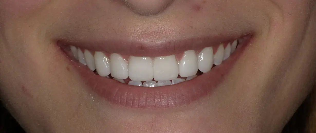 Veneers After Image 01