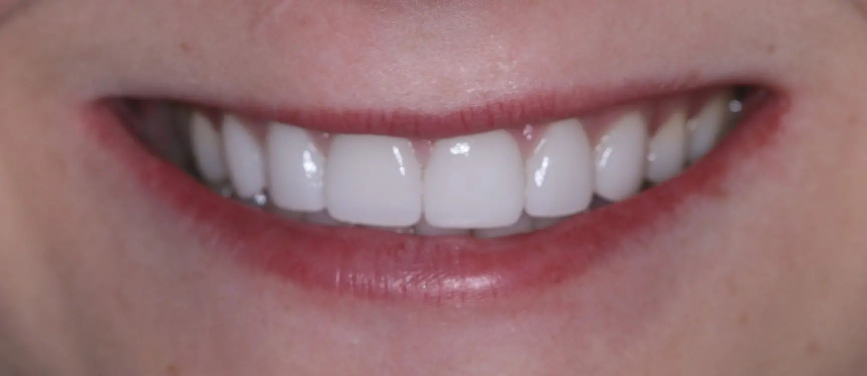 Veneers After Image 02