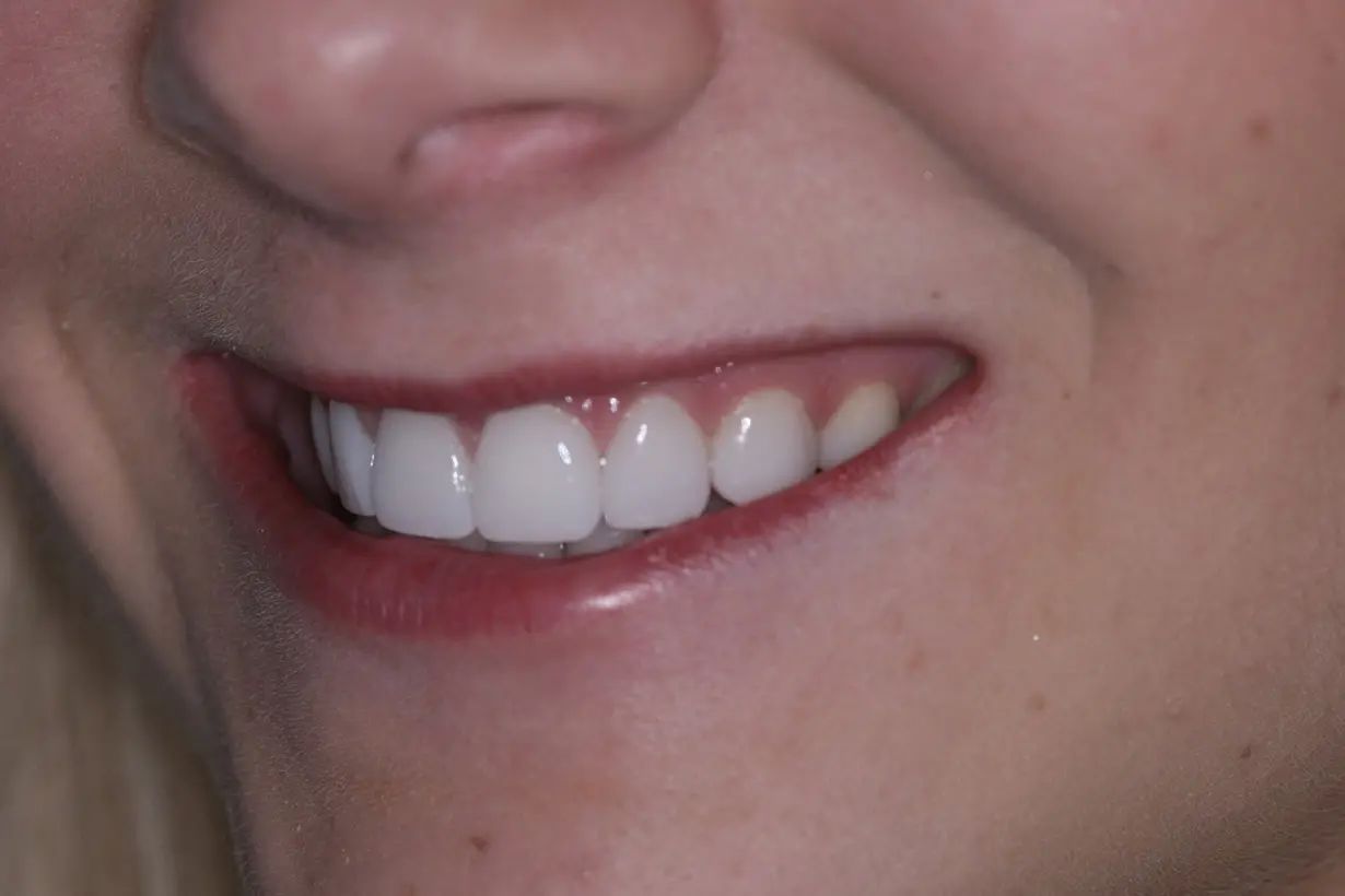 Veneers After Image 04