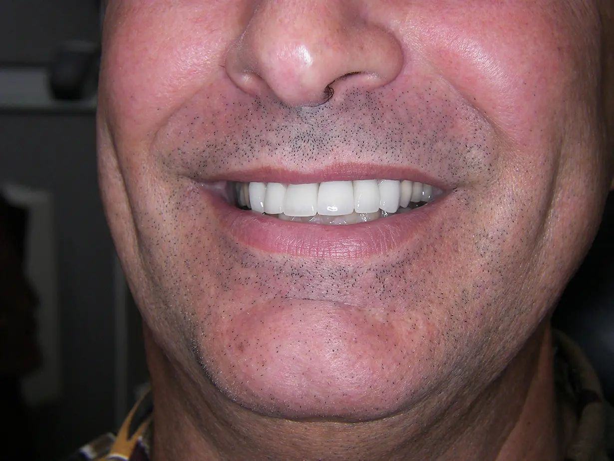 Dental Implants after treatment results of a patient