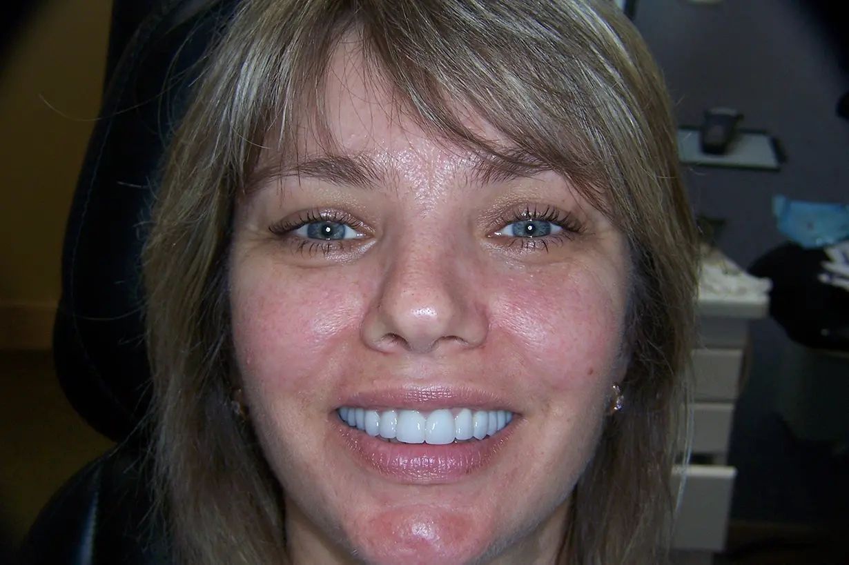 After Crowns of a young lady