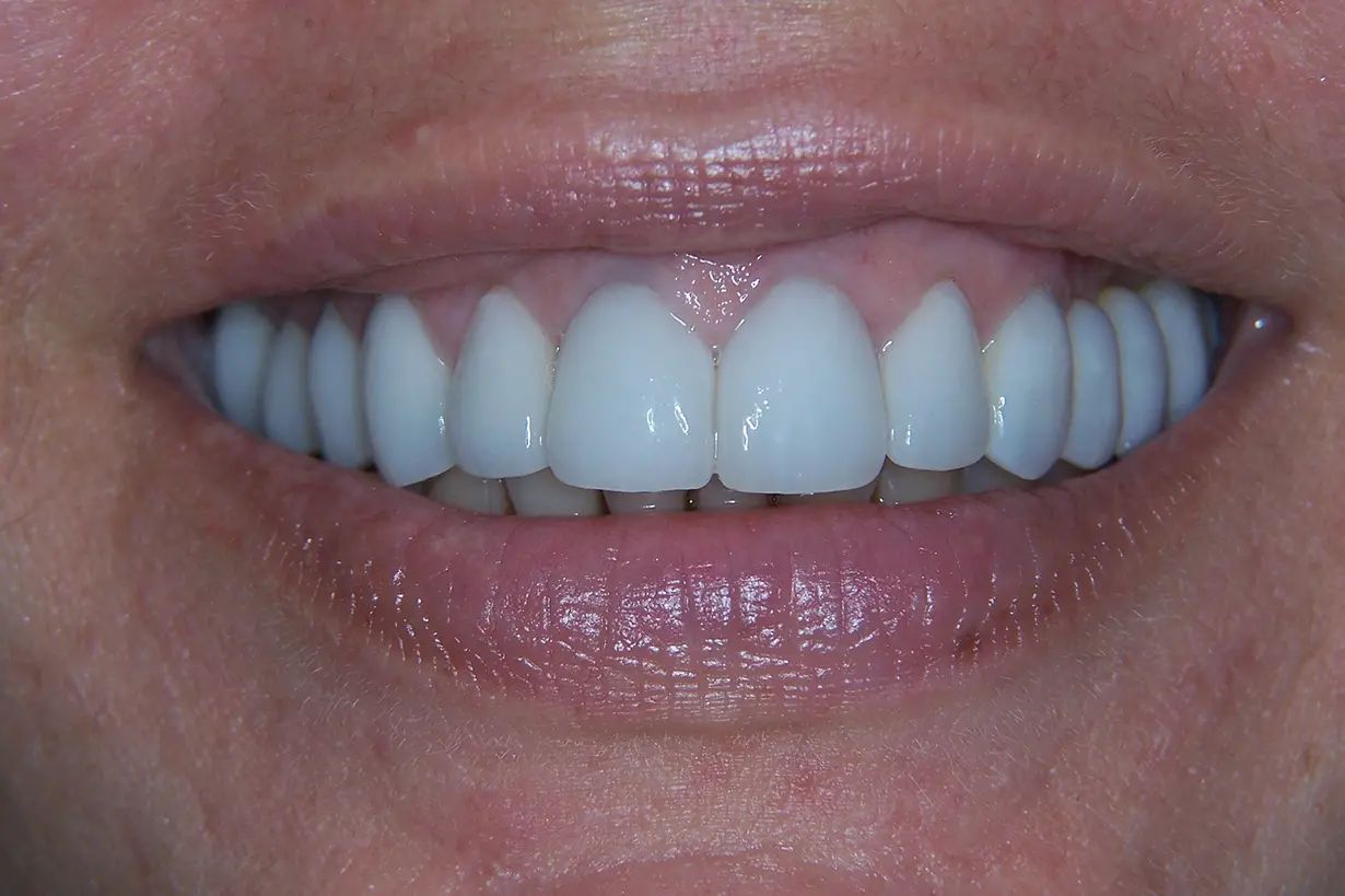 Veneers & Dental Crowns After 02