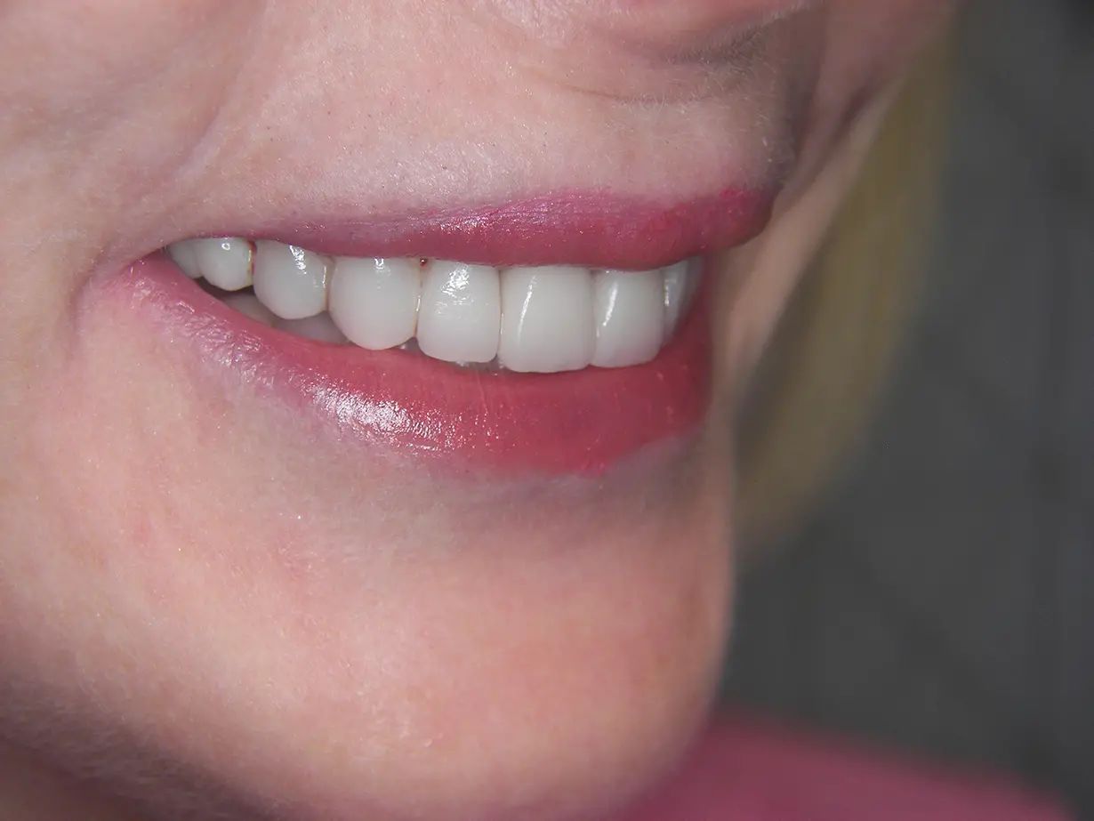 Veneers & Dental Crowns After 03