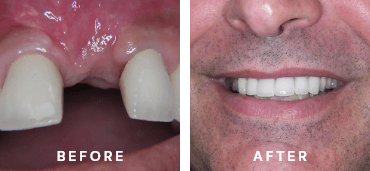 Dental Implants Before and After