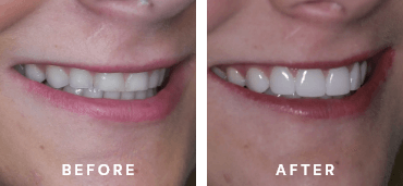 DuraThin Veneers Before and After