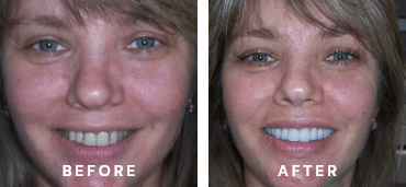 Veneers & Dental Crowns Before and After