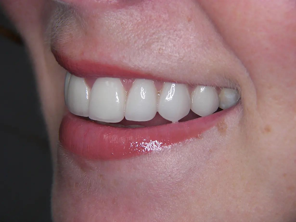 Veneers After Image 05