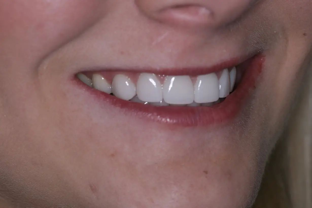 DuraThin Veneers After 03